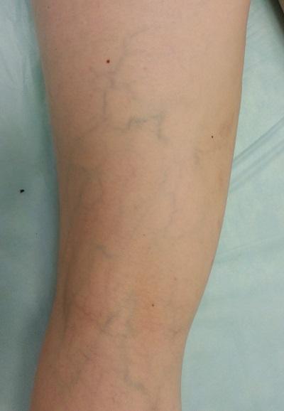 Velichko do sclerotherapii 2
