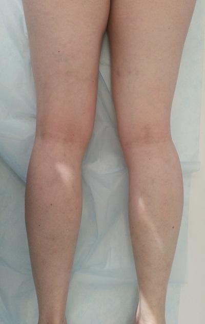 Velichko posle sclerotherapii 2