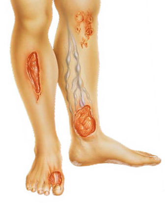 Трофические язвы на ногах