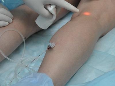 EVLK procedure of small saphenous vein performed by Dr. Semenov A.Yu