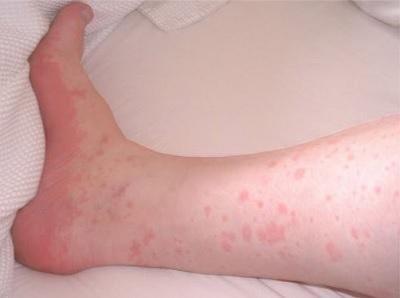 Аллергический дерматит после применения венотонизирующего геля