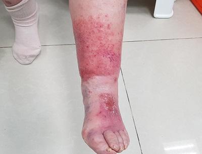 Рожистое воспаление на ноге у нашей пациентки