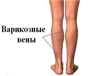 Varicose veins in the legs are the cause of them