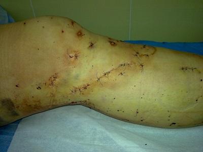 Varicosis treatment surgical