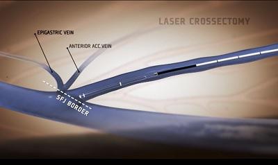 Видео эндовенозной лазерной коагуляции (ЭВЛК)