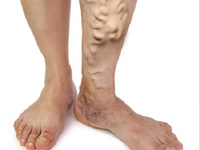 What can be caused by improper treatment of varicose veins