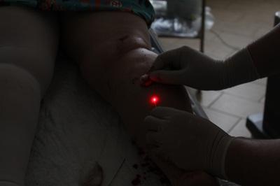 Сергей Геннадьевич Грачев проводит эндовенозную лазерную коагуляцию малой подкожной вены
