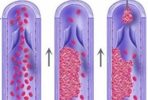 Механизм развития тромбоэмболии при тромбофлебите