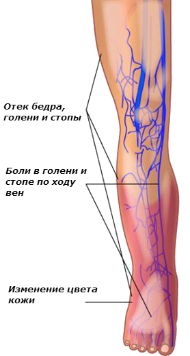 признаки тромбофлебита