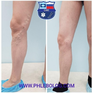 Варикоз в области правого коленного сустава