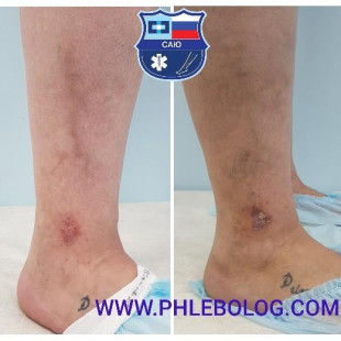 Трофической венозная экзема - лечение лазером