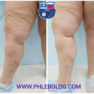 Тромбофлебит в бассейне БПВ справа - лечение лазером