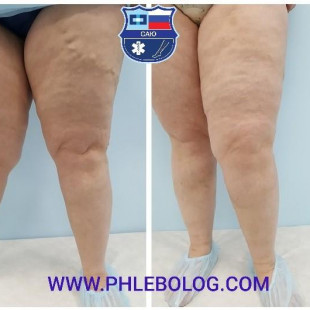 Лазерная коагуляция и минифлебэктомия по Варади