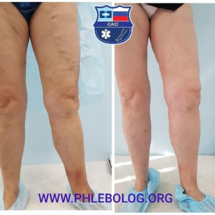 Трофическая экзема - лечение лазером и минифлебэктомией