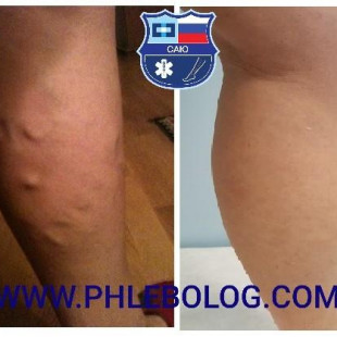 Радиочастотная абляция вен нижних конечностей