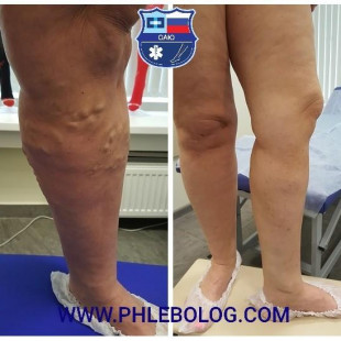 Лечение варикоза методом РЧА на ногах