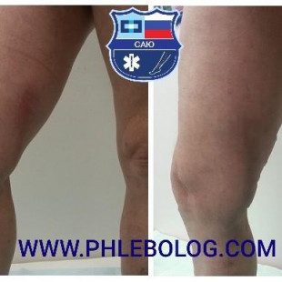 Тромбоз в бассейне БПВ на правой нижней конечности