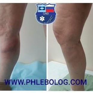 Варикотромбофлебит в бассейне БПВ справа