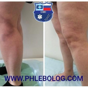 Тромбоз притока БПВ - лечение новым лазером