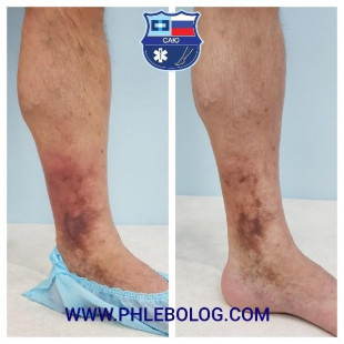 Острый тромбоз на фоне трофической экземы