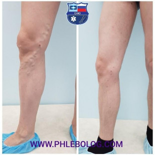 Мужской варикоз на правой нижней конечности