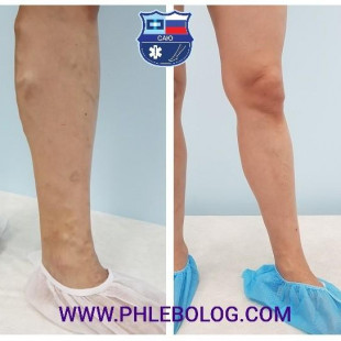 РЧО вен левой нижней конечности - без разрезов и шрамов