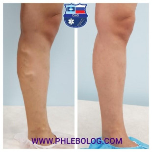 Пенная склеротерапия вен на левой голени  - одна процедура