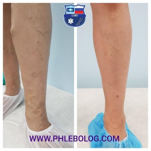 Склеротерапия варикозных вен на левой голени - 2 сеанса