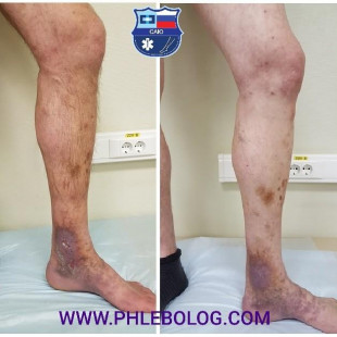 Трофическая язва левой голени - лечение лазером