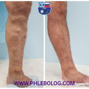 Лечение варикоза лазером с новой длиной волны 1940 Нм