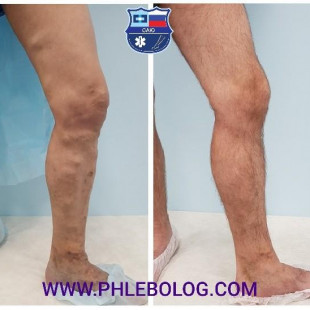 Минифлебэктомия при лечении варикоза