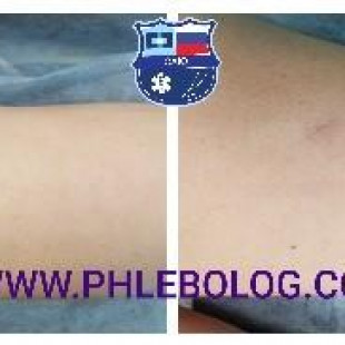 Сосудистые звёздочки можно удалить