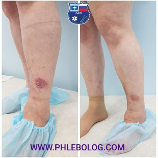 Трофическая экзема - лечение лазером