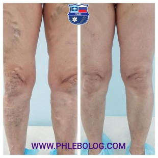 Лазерное лечение варикоза на обеих нижних конечностях