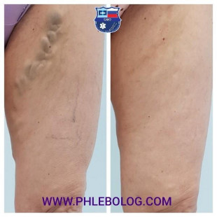 Удаление варикозных вен методом минифлебэктомии по Варади