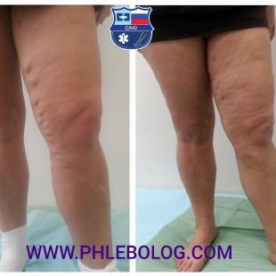 Запущенный варикоз - лечение методом ЭВЛО 