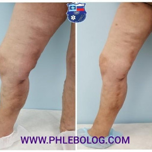 Острый тромбофлебит в бассейне БПВ справа