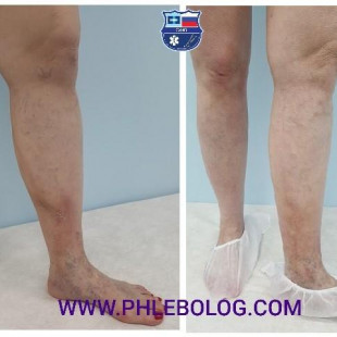 Тромбофлебит в области трофических расстройств 