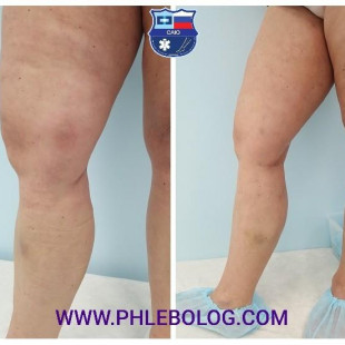 Тромбофлебит - лечение ЭВЛК - лазерной коагуляцией