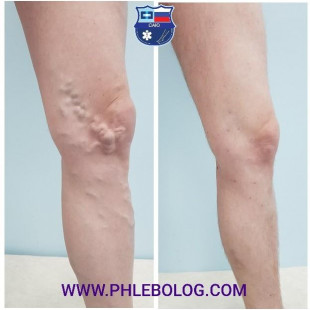 Варикоз в области колена - лечение с помощью минифлебэктомии по Варади