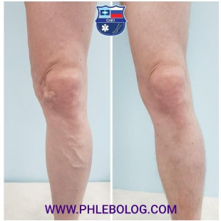 Foam-form склеротерапия варикозных вен