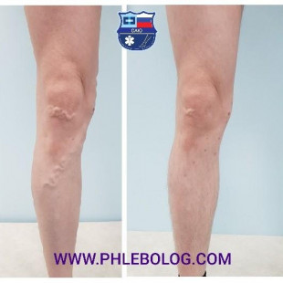 Пенная склеротерапия расширенных вен