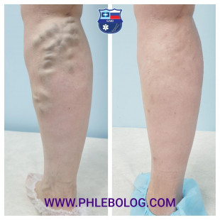 Лечение варикоза лазером - ЭВЛК вен на ногах