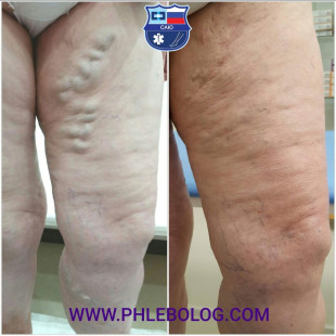Минифлебэктомия по Варади слева