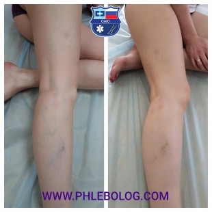 Удаление вен на ногах с помощью пенной склеротерапии