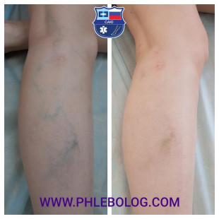 Foam-form склеротерапия варикозных вен на правой голени - 1 сеанс