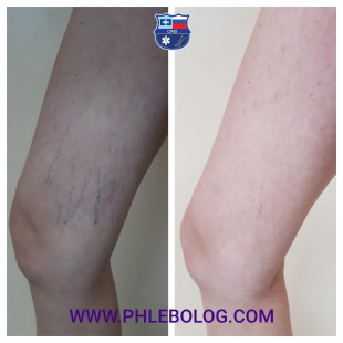 Удаление звездочек на внутренней поверхности бедра