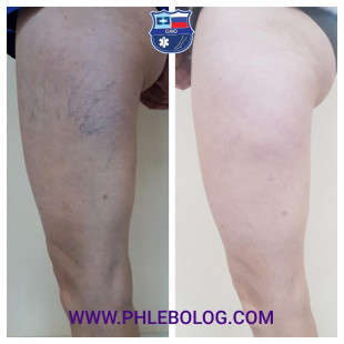 Как удалить сосудистые звездочки