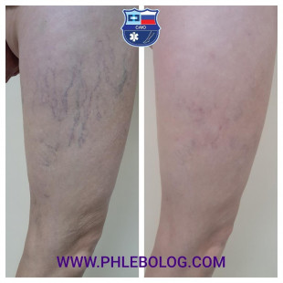 Как убрать сосудистые звездочки