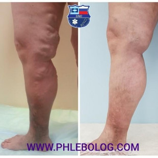 Огромный варикоз с венозной экземой - лечение лазером